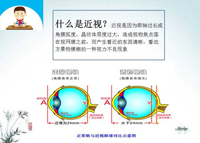 近視產(chǎn)生的原因